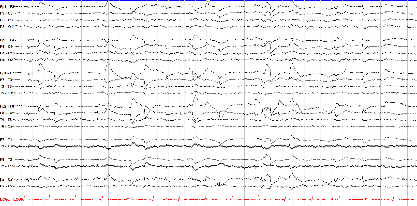The Normal Asleep EEG